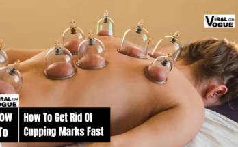 How to Get Rid of Cupping Marks Fast