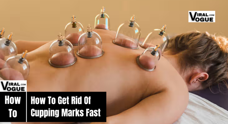 How to Get Rid of Cupping Marks Fast