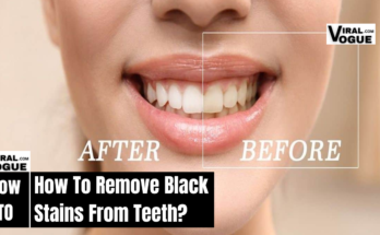 How To Remove Black Stains From Teeth