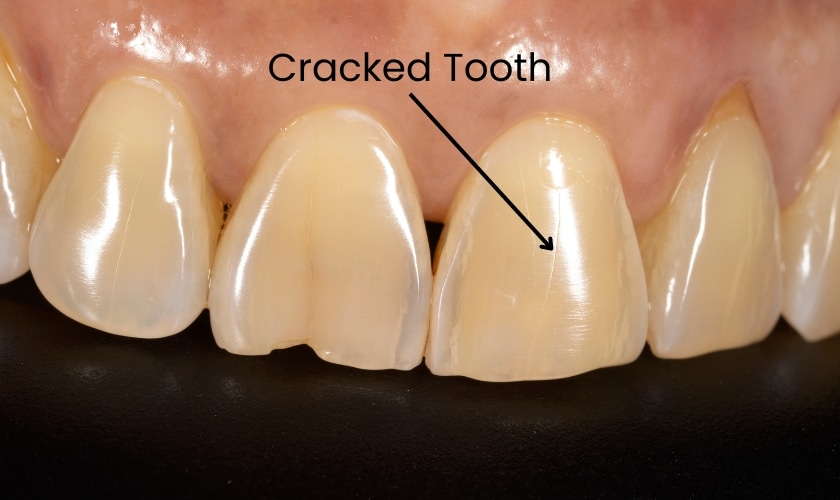 How to Fix a Cracked Tooth Naturally